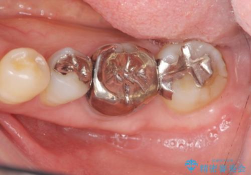 [ セラミック治療 ]目立つ奥歯の銀歯を白くするの治療前