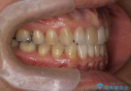【前歯の隙間】インビザラインですきっ歯の矯正治療の治療後