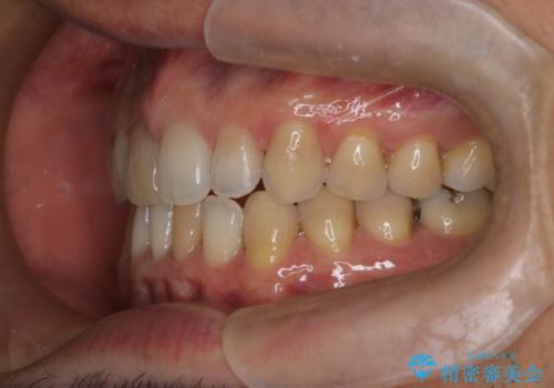 【前歯の隙間】インビザラインですきっ歯の矯正治療の治療後