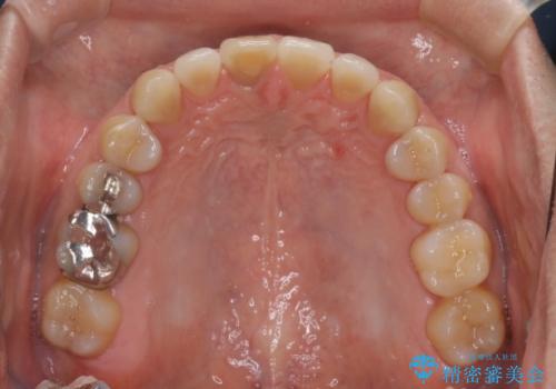 【前歯の隙間】インビザラインですきっ歯の矯正治療の治療後