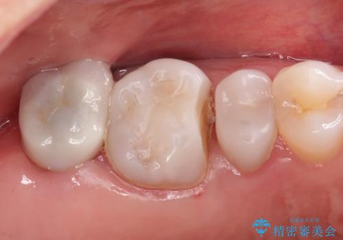 保険で治療した歯が欠けた。オールセラミッククラウンによる修復の症例 治療前