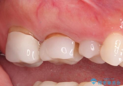保険で治療した歯が欠けた。オールセラミッククラウンによる修復の治療前