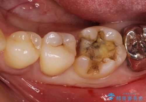 金属の詰め物がはずれた。の症例 治療前