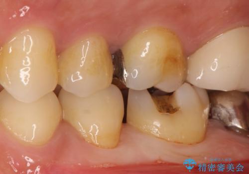 金属の詰め物がはずれた。の治療前