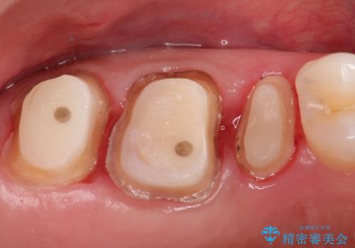 保険で治療した歯が欠けた。オールセラミッククラウンによる修復の治療中