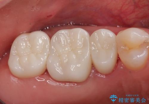 保険で治療した歯が欠けた。オールセラミッククラウンによる修復の症例 治療後