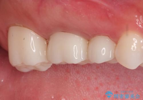 保険で治療した歯が欠けた。オールセラミッククラウンによる修復の治療後