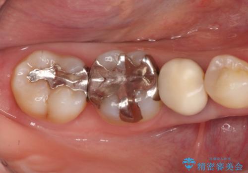 笑った時に見える金属を白くしたいの治療前