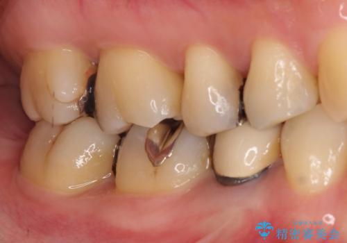 笑った時に見える金属を白くしたいの治療前