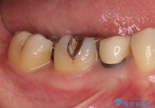 笑った時に見える金属を白くしたいの治療前