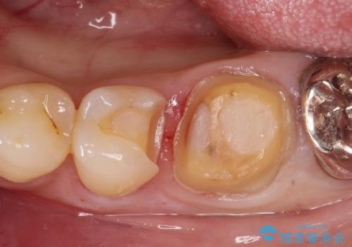 金属の詰め物がはずれた。の治療中