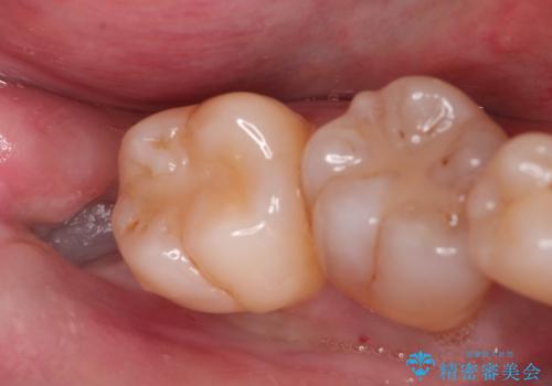 親知らずが原因の深いむし歯の症例 治療前