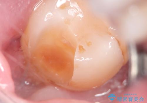 親知らずが原因の深いむし歯の治療中
