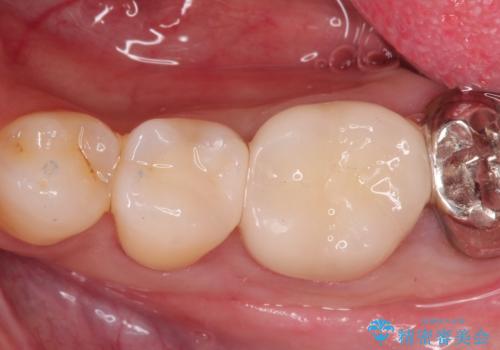 金属の詰め物がはずれた。の症例 治療後