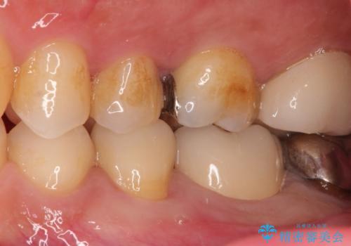 金属の詰め物がはずれた。の治療後