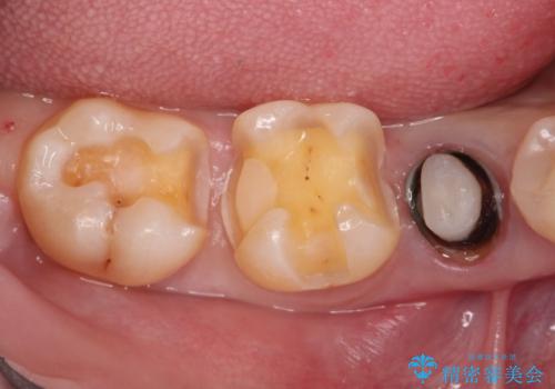 笑った時に見える金属を白くしたいの治療中