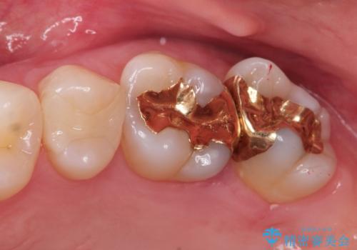 他院で入れたインレーの下にむし歯、ゴールドインレーで修復の症例 治療前