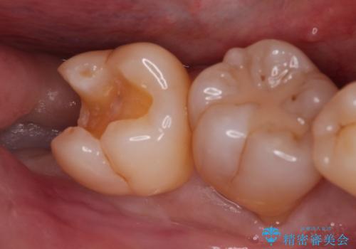 親知らずが原因の深いむし歯の治療中