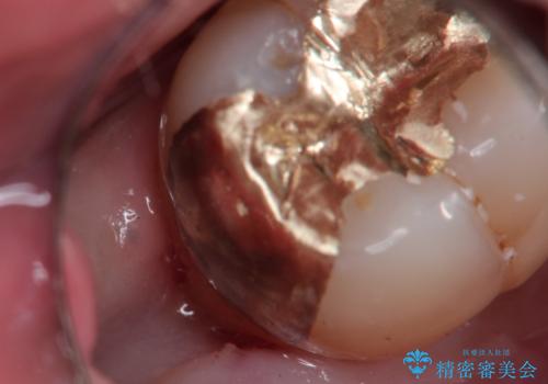 親知らずが原因の深いむし歯の治療後