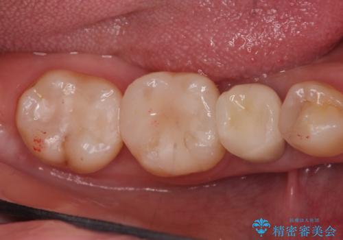 笑った時に見える金属を白くしたい