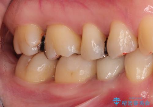 笑った時に見える金属を白くしたいの治療後