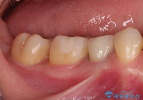 笑った時に見える金属を白くしたいの治療後