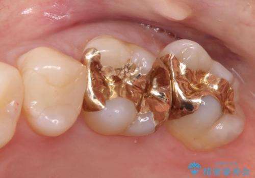 他院で入れたインレーの下にむし歯、ゴールドインレーで修復