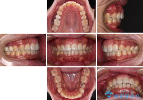 インビザラインによる矯正治療と、折れてしまった歯のインプラント補綴治療の治療後