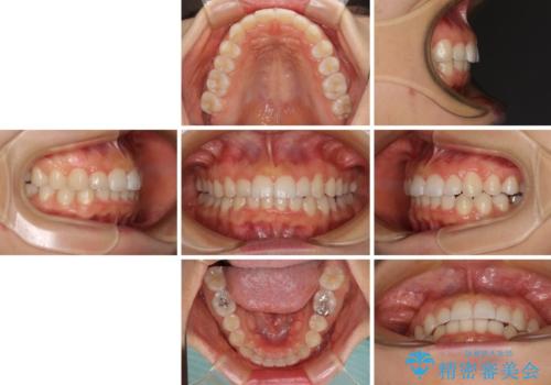 前歯のデコボコと突出感 インビザラインによる矯正治療の治療後