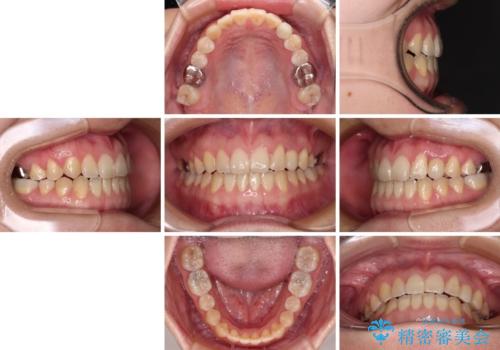 受け口で開咬を急速拡大装置とインビザラインで改善　欠損部分はインプラントにて補綴治療の治療後