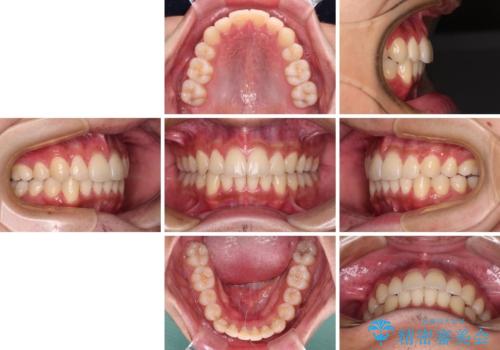 矯正治療の後戻りをインビザライン・ライトで解消の治療後