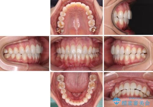 少しだけ飛び出た前歯を整えたい インビザラインによる矯正治療の治療後