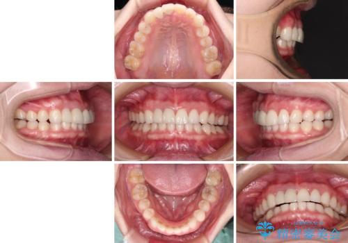 一度諦めた矯正にチャレンジしたい インビザラインとセラミック治療の治療後