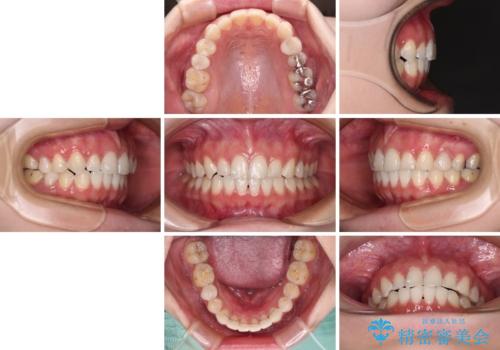 インビザライン単独では困難 補助装置を併用した矯正治療の治療後