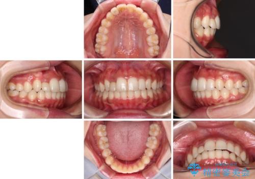 抜けてしまうと言われた前歯 インビザラインによる矯正治療の治療後
