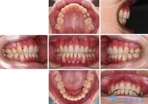 前歯の歯並びを治したい ワイヤー装置での抜歯矯正の治療後