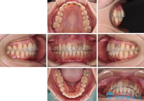 内側にある歯が邪魔 重なった前歯の歯列矯正の治療後
