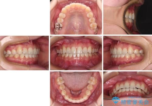 奥歯の欠損を放置 大臼歯を抜歯した矯正治療の治療後