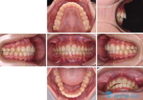 下の前歯が隠れてしまうほど深い咬み合わせ 高校生のインビザライン矯正治療の治療後