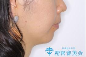 矮小歯を綺麗な歯に。矯正とセラミックの総合治療の治療後(顔貌)