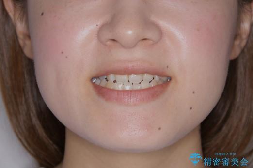 歯がないところに歯をつくる:矯正とセラミックの合わせ技で審美的な口元をの治療前（顔貌）