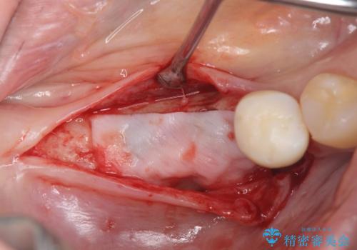 インプラント治療による咬合機能回復の治療中