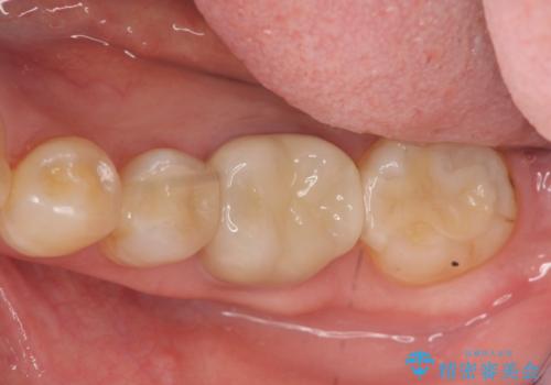 [ セラミック治療 ]目立つ奥歯の銀歯を白くするの治療後