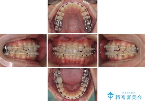 受け口傾向の咬み合わせ　前歯のデコボコをワイヤー矯正で素早く改善の治療中