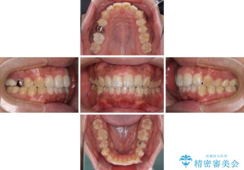 インビザラインによる矯正治療と、折れてしまった歯のインプラント補綴治療の治療中