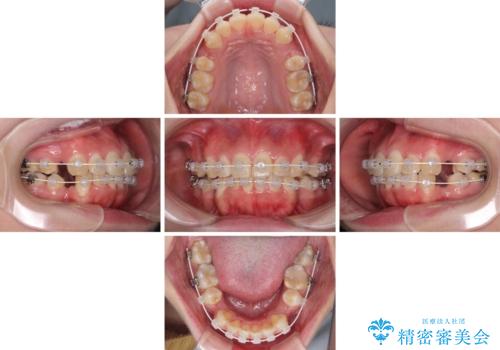 前歯の出っ歯と口の閉じにくさを抜歯矯正で改善 目立たないワイヤー矯正の治療中