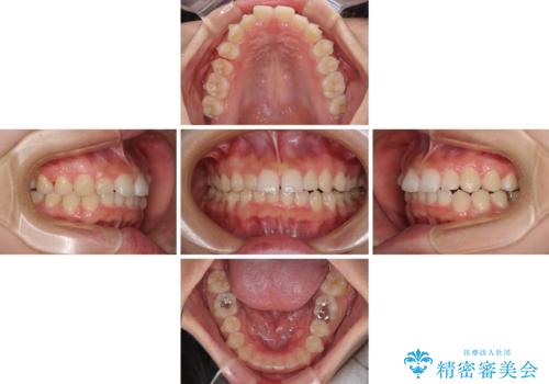 前歯のデコボコと突出感 インビザラインによる矯正治療の治療中