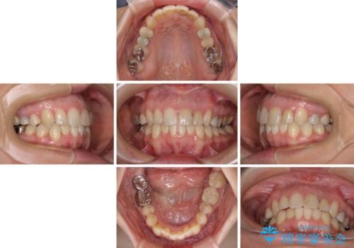 【モニター】前歯のデコボコと奥歯の虫歯　インビザライン治療と奥歯のセラミック治療の治療中