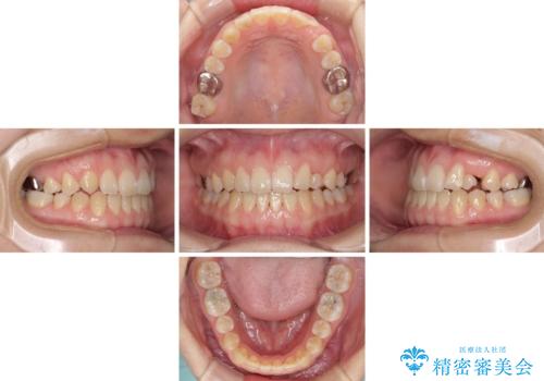 受け口で開咬を急速拡大装置とインビザラインで改善　欠損部分はインプラントにて補綴治療の治療中