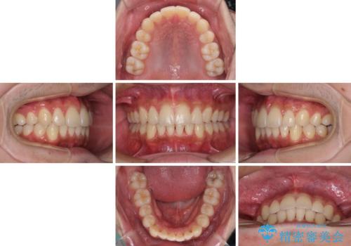 矯正治療の後戻りをインビザライン・ライトで解消の治療中